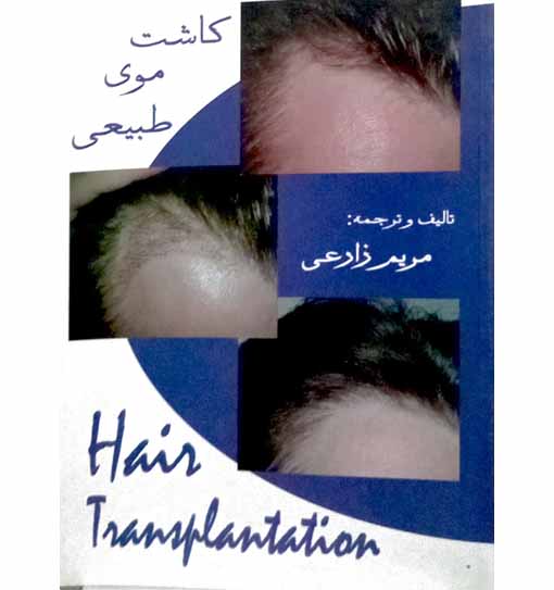 کاشت موی طبیعی